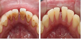 齦上/下潔治（洗牙）、齲齒充填（補(bǔ)牙）