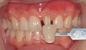 全瓷冠、美學樹脂修復