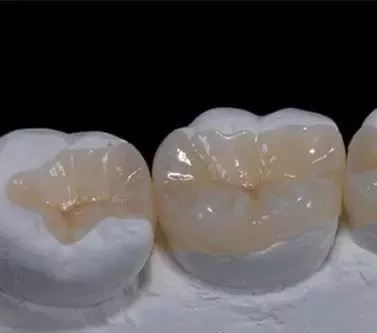 牙體缺損修復(fù)（如嵌體）