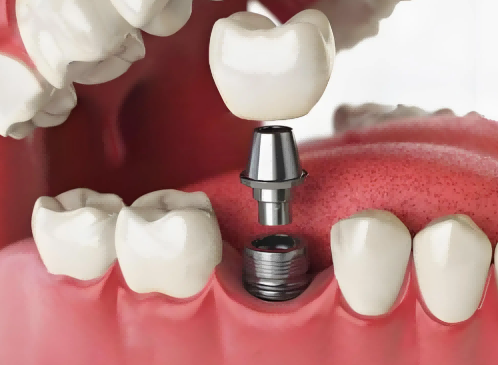 單顆/多顆種植牙、即刻種植