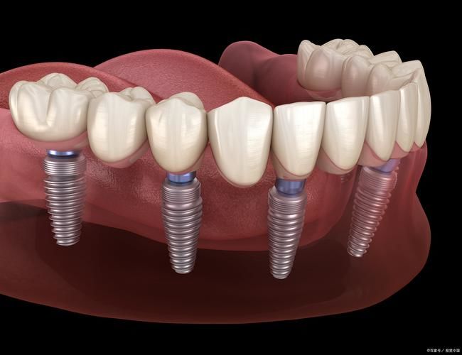 全口牙種植要怎么護(hù)理?