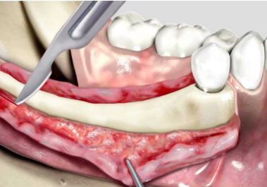 種植骨增量手術(shù)（上頜竇提升）
