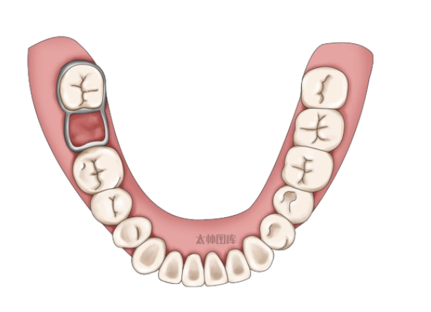咬合誘導矯正、間隙保持器