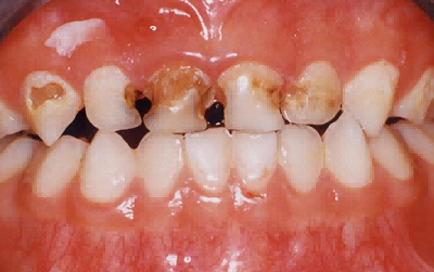 乳牙齲齒防治（乳牙根管*、預(yù)成冠）