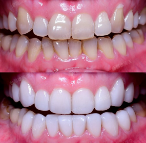 牙齒貼面可以矯正牙齒嗎?