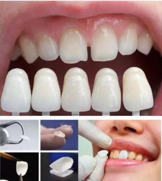 牙齒貼面能吃硬東西嗎?